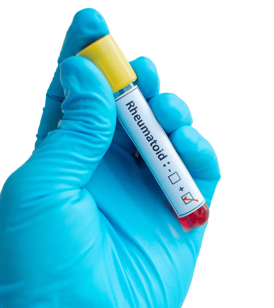 Diagnosis and test for rheumatoid arthritis in Noida, India dr. Kiran Seth