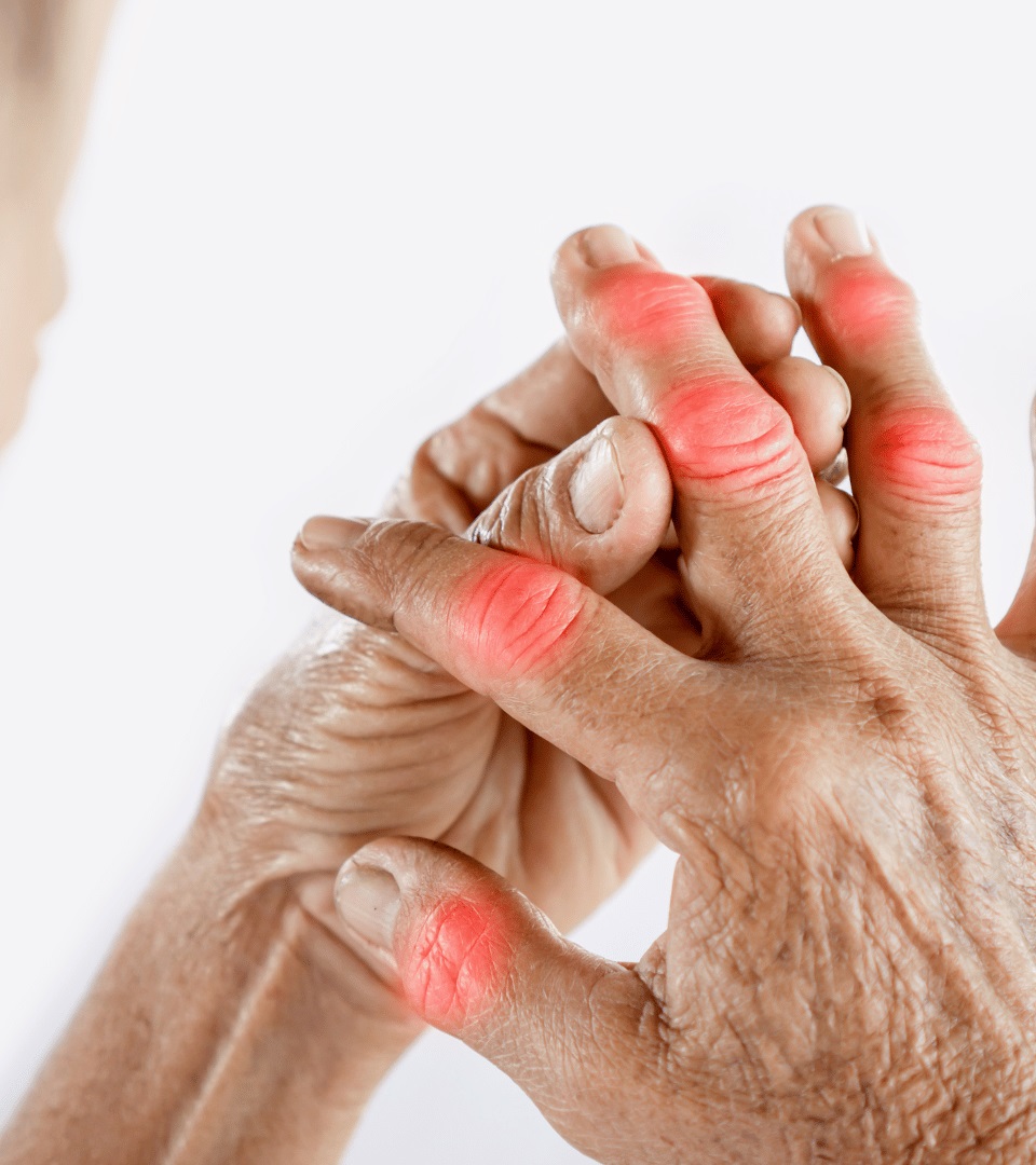 Overview Gout : Causes and Symptoms in Noida