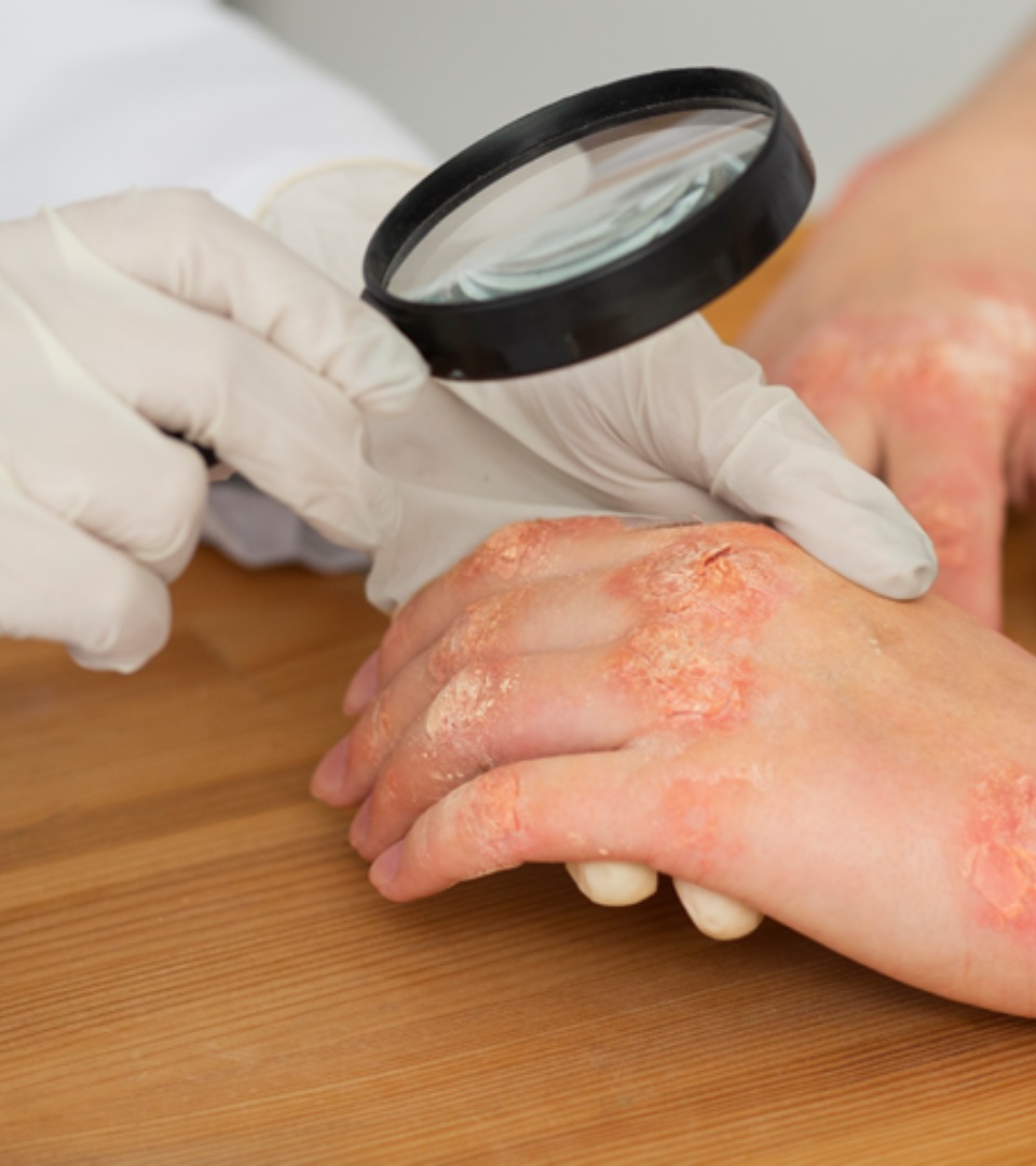 Types of psoriatic arthritis in Noida, India dr. Kiran Seth