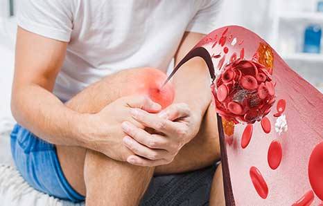 How long will my hip or knee replacement last?