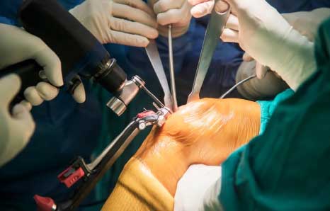 कोविड-19 महामारी के दौर में ज्वाइंट रिप्लेसमेंट सर्जरी