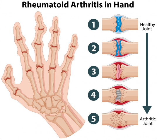 Best Rheumatoid Arthritis Treatment in Noida