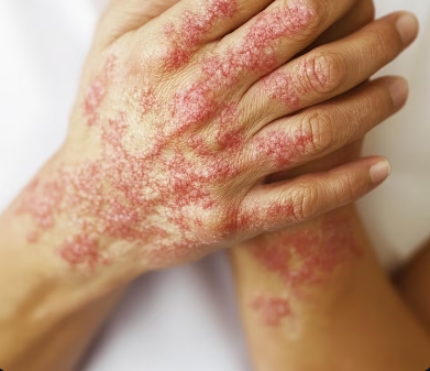 Psoriatic Arthritis Treatment in Greater Noida