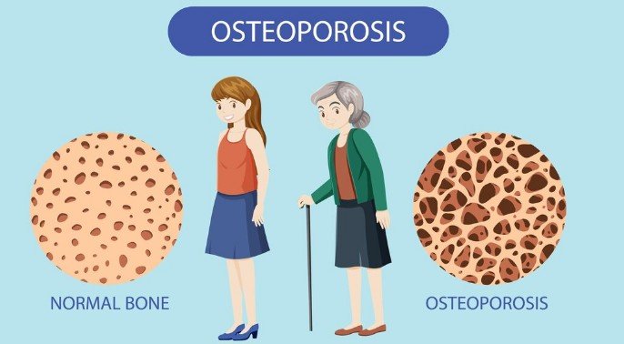 Osteoporosis Doctor in Mayur Vihar