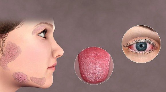 Sjogren’s Disease Treatment in Greater Noida