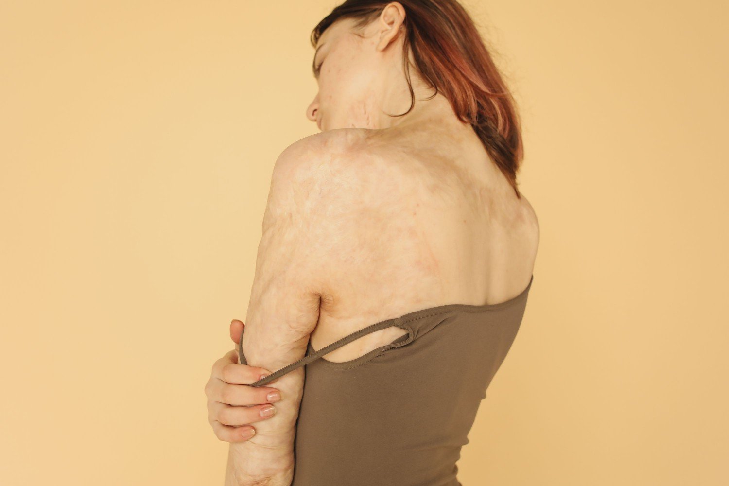 Mixed Connective Tissue Disease Treatment in Ashok Vihar